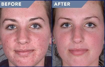 Before and after Acne Treatment results at Viore Laser Skincare MedSpa, example 2