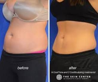 Before and after CoolSculpting Fat Reduction results at Viore Laser Skincare MedSpa, example 2