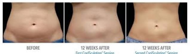 Before and after CoolSculpting Fat Reduction results at Viore Laser Skincare MedSpa, example 3