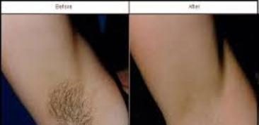 Before and after Laser Hair Removal results at Viore Laser Skincare MedSpa, example 1