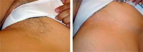 Before and after Laser Hair Removal results at Viore Laser Skincare MedSpa, example 2