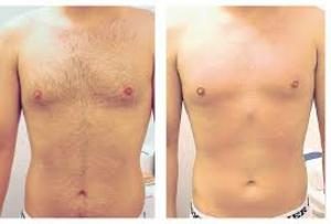 Before and after Laser Hair Removal results at Viore Laser Skincare MedSpa, example 3