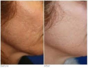 Before and after Microneedling results at Viore Laser Skincare MedSpa, example 3