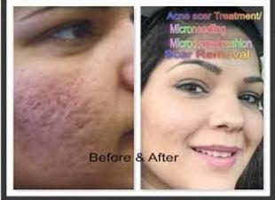 Before and after Microneedling results at Viore Laser Skincare MedSpa, example 4