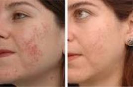 Before and after IPL & BBL Photo Facial results at Viore Laser Skincare MedSpa, example 2