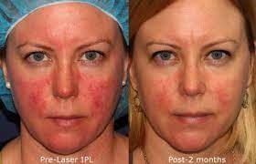 Before and after IPL & BBL Photo Facial results at Viore Laser Skincare MedSpa, example 4