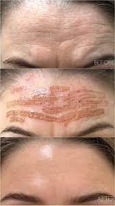 Before and after Plasma Fibroblast Skin Tightening results at Viore Laser Skincare MedSpa, example 1