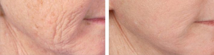 Before and after Radio Frequency Microneedling results at Viore Laser Skincare MedSpa, example 1