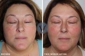 Before and after Spider Vein Treatment results at Viore Laser Skincare MedSpa, example 2